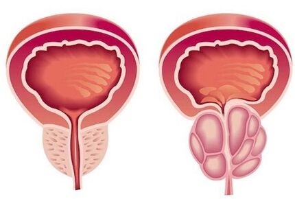 Symptome einer Prostatitis bei Männern